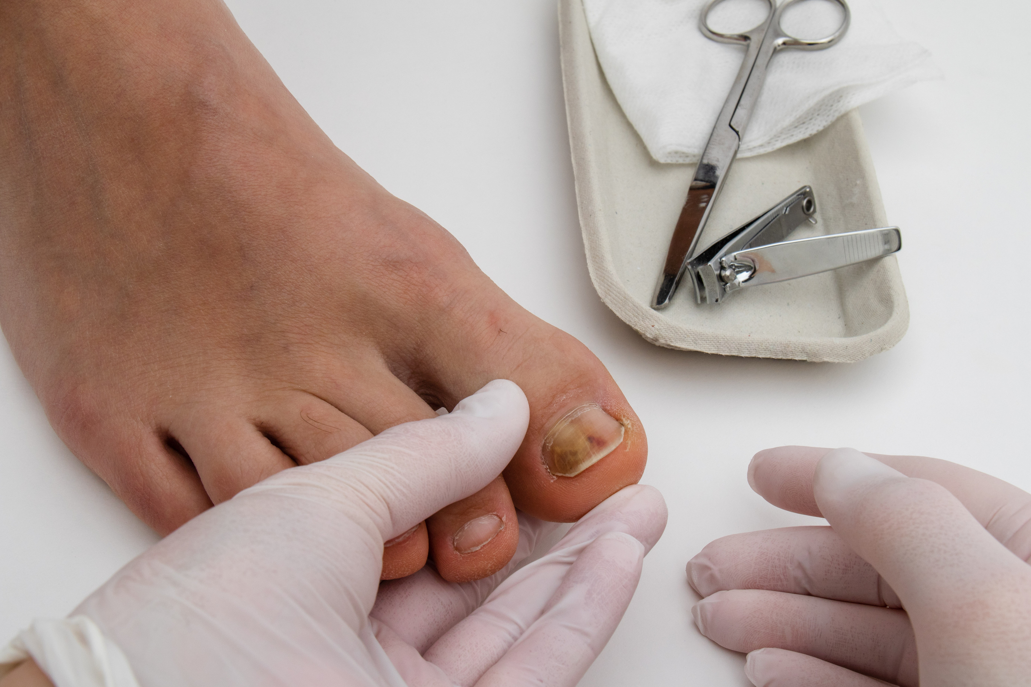 A foot with the nail on big toe with onychopathy, nail fungus and bruise.