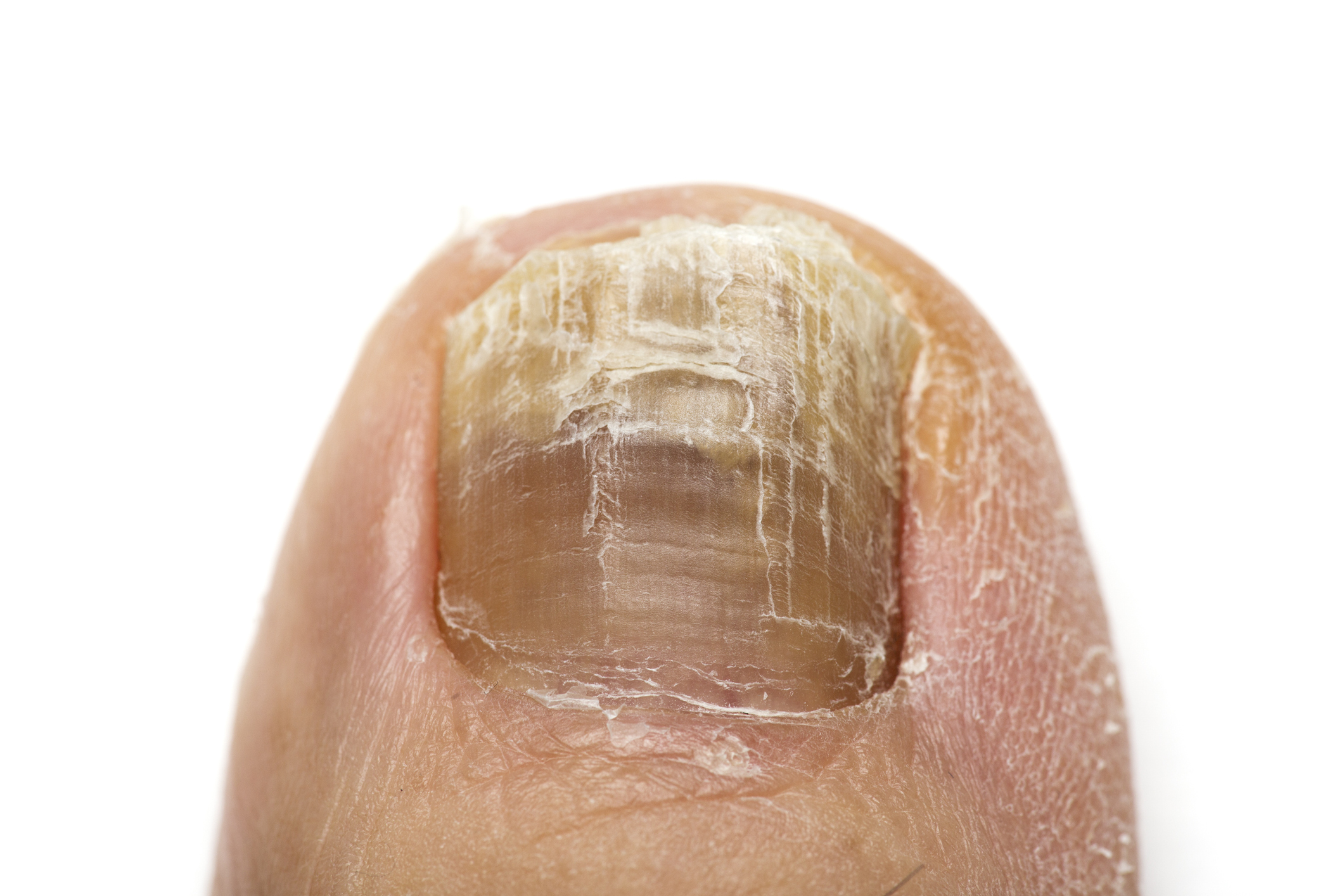 Toenail with fungus close up on white.